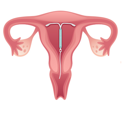 “Illustration of an intrauterine device (IUD) placed inside the uterus for birth control.”
