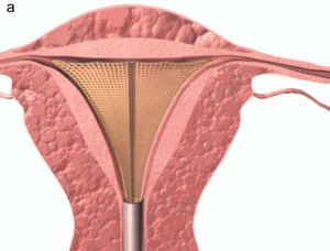 “Illustration of an endometrial ablation device expanding inside the uterus to treat heavy menstrual bleeding.”