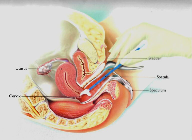 “Illustration of a Pap test showing a speculum and spatula collecting cervical cells for screening.”